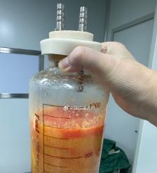 新安水动力吸脂手术要做多久？